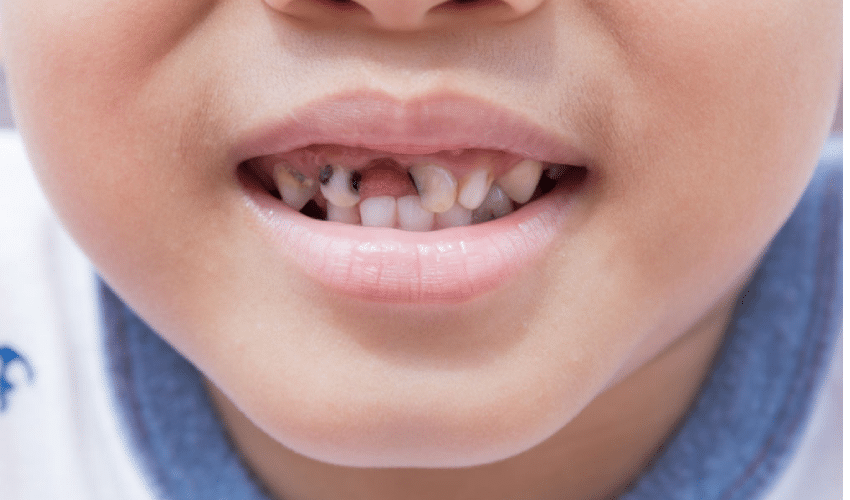 Featured image for “6 Ways to Prevent Cavities in Children”