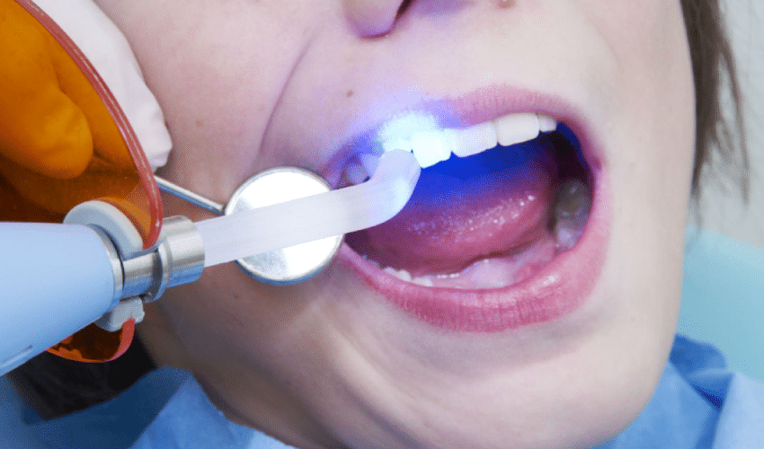Featured image for “6 Questions To Ask Your Pediatric Dentist About Dental Sealants”