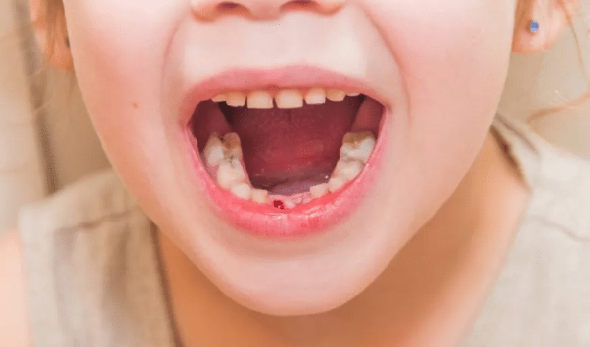 Featured image for “Bleeding Gums in Children: What Should You Do?”