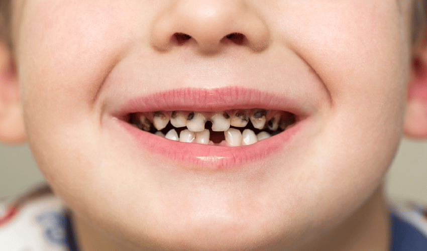 Featured image for “How To Protect Your Child’s Teeth From Cavities”