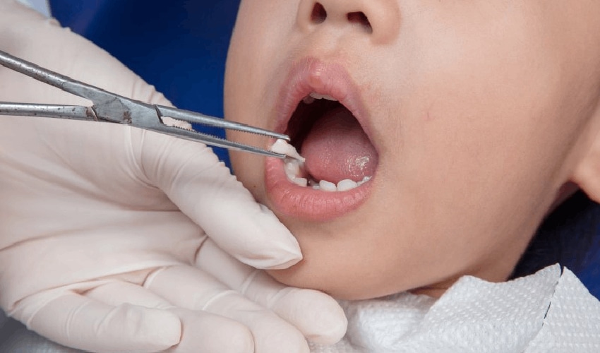 Featured image for “5 Essential Tips for Helping Your Child Recover After a Tooth Extraction”