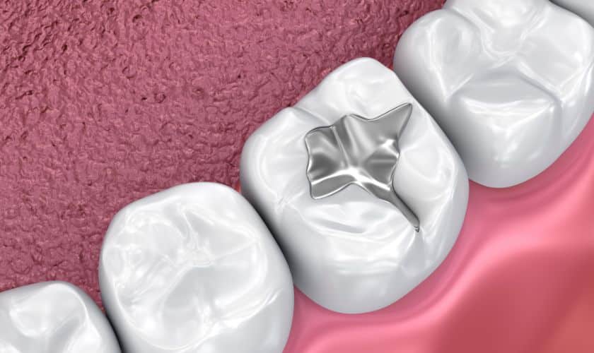 Dental Sealants in West Jordan