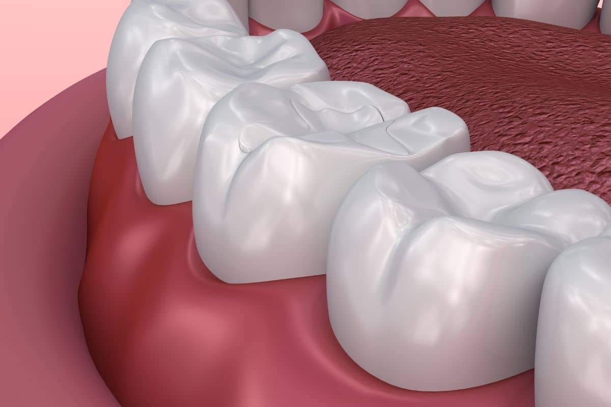 Featured image for “How Long Do Dental Sealants Last? What Parents Need to Know”