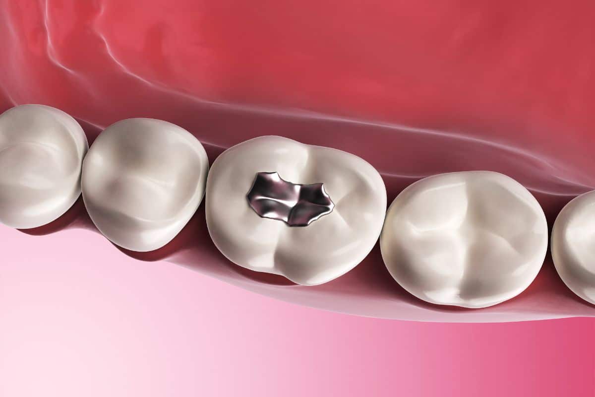 Dental fillings West Jordan