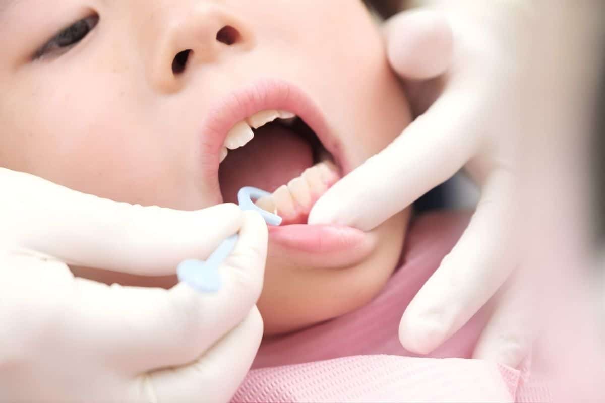 How Soon Can My Child Eat After Getting Dental Sealants?