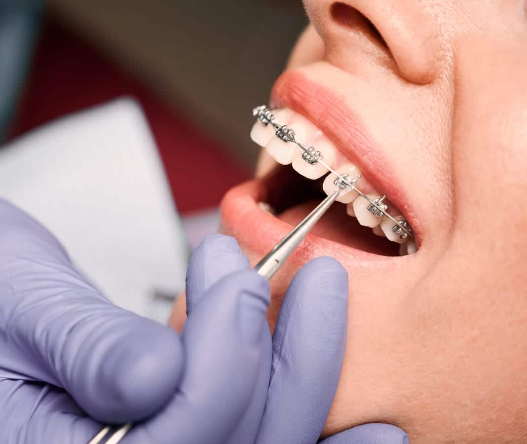 How to prevent cavities in kids in Oquirrh